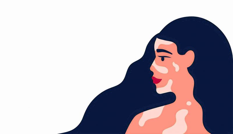 本周严选：张掖中医白癜风医院怎么样 女性脸上白癜风复发怎么办?